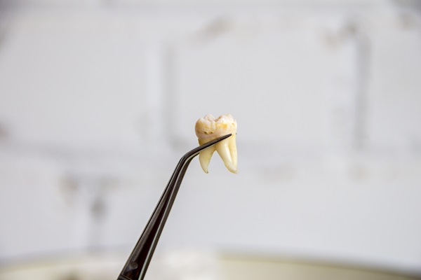 Tooth Extraction For Wisdom Teeth